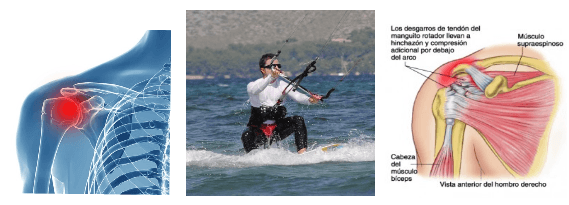 6 Schulterverletzungen-kitesurfen